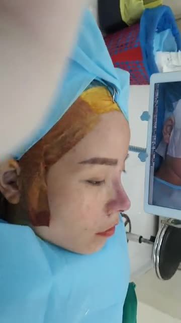 Hình ảnh ngay sau phẫu thuật mũi cấu trúc đã livestream ở phía trước.