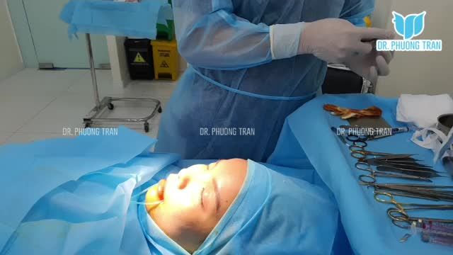 NÂNG MŨI CẤU TRÚC CẤY MỠ MI DƯỚI  LÀM ĐẦY RÃNH MŨI MÁ BẰNG MỠ TỰ THÂN