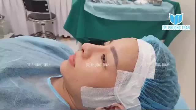 BÁC SĨ PHÂN TÍCH CA MŨI ĐÃ SỬA RỒI NHƯNG CHƯA ƯNG Ý: SỐNG MŨI QUÁ CAO VÀ ĐẦU MŨI QUÁ DÀI THÌ NÊN SỬA LẠI THẾ NÀO?