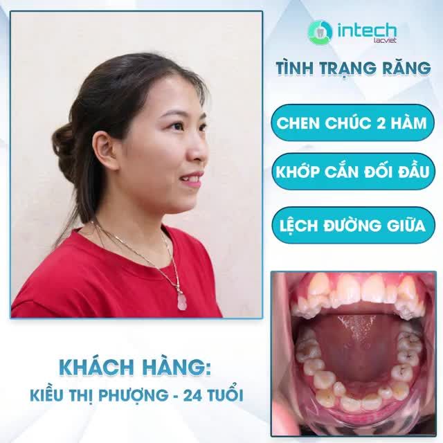 NIỀNG RĂNG MẮC CÀI SỨ GIẢI PHÁP NIỀNG RĂNG ĐẢM BẢO THẨM MỸ DỊP CUỐI NĂM