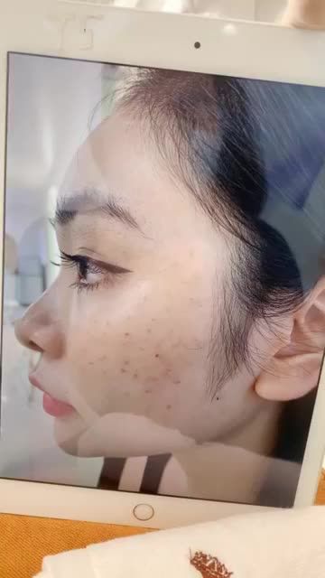 CẤP ẨM HA PHỤC HỒI DA SAU KHI TRỊ TÀN NHANG, DA CĂNG BÓNG ĐẦY ĐỦ ĐỘ ẨM