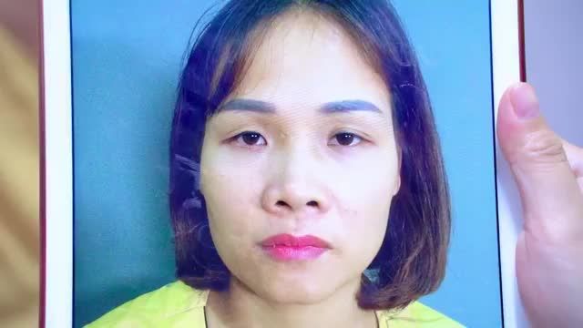 Mắt tỷ lệ chênh lệch không đều gấy mất tự tin... vị khách hàng quyết tâm thẩm mỹ và nhận cái kết đẹp ngoài sự mong đợi