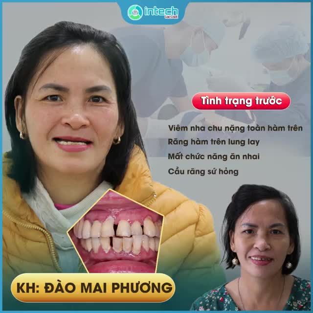 TẠM BIỆT CẦU RĂNG SỨ, GIỜ CÔ TRỒNG RĂNG IMPLANT ĐỂ ĂN NHAI NGON MIỆNG HƠN