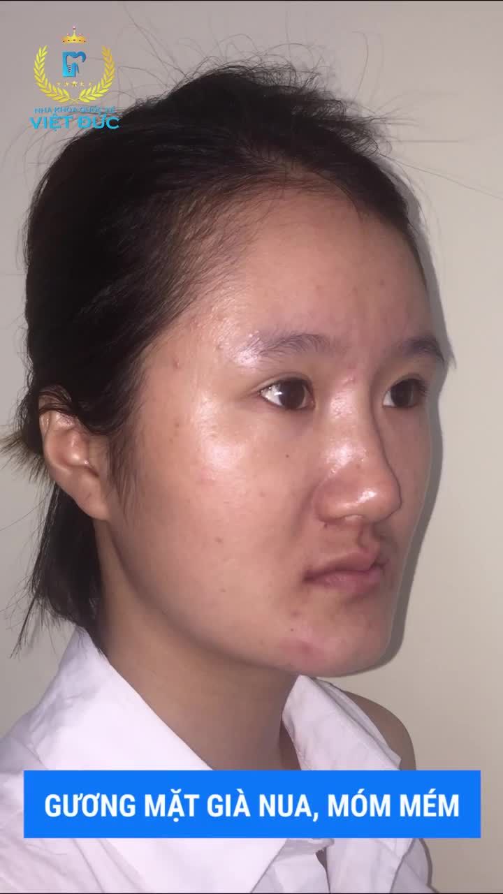 “CẢM ƠN NHA KHOA QUỐC TẾ VIỆT ĐỨC ĐÃ TÁI SINH MỘT NGUYỄN THỊ NHUNG XINH ĐẸP VÀ TỰ TIN HƠN”