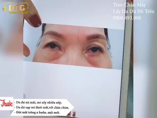 Khách hàng vừa thực hiện Ca treo chân mày