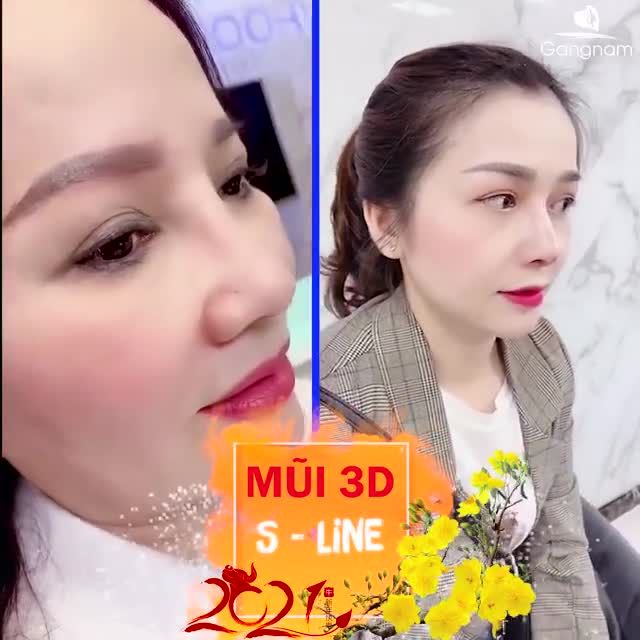 NÂNG MŨI SAU BAO LÂU THÌ ĐẸP ỔN ĐỊNH?