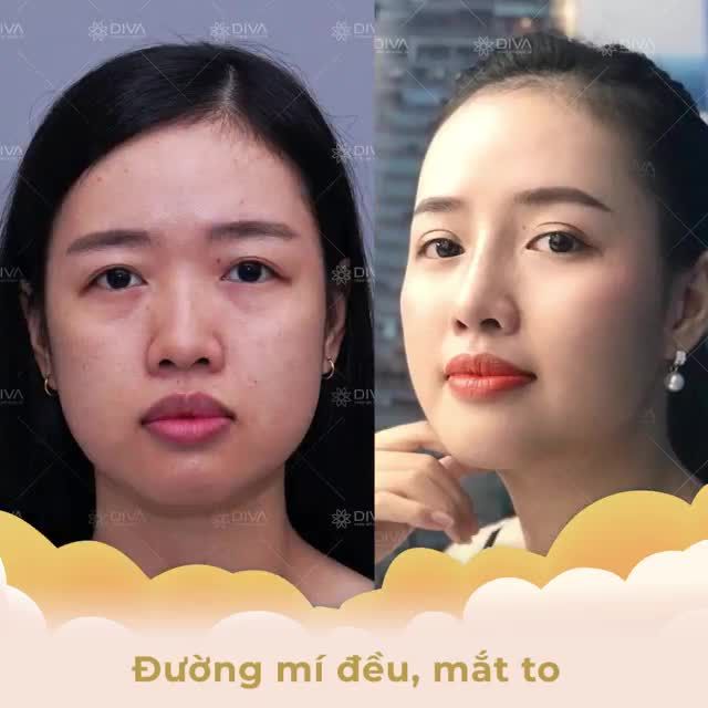 NHẤN MÍ MẮT TẠI THẨM MỸ QUỐC TẾ DIVA MẮT 2 MÍ ĐỀU, TO TRÒN PHÚC HẬU