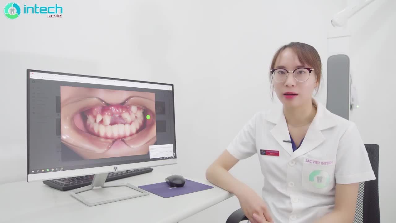 PHÂN TÍCH LÂM SÀNG CA NIỀNG RĂNG KHẤP KHỂNH NẶNG Ở TRẺ THAY ĐỔI NGOẠN MỤC SAU 5 THÁNG