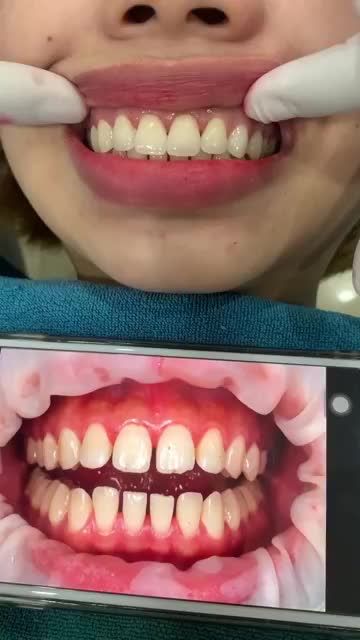 Sự thay đổi của khách hàng sau khi làm răng sứ thẩm mỹ