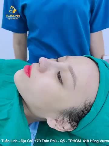 Tại phòng phẫu thuật VTM Tuấn Linh Khách hàng : NÂNG MŨI BỌC SỤN "SƯƠNG SƯƠNG" - SỞ HỮU NGAY DÁNG MŨI " SIÊU PHẨM"