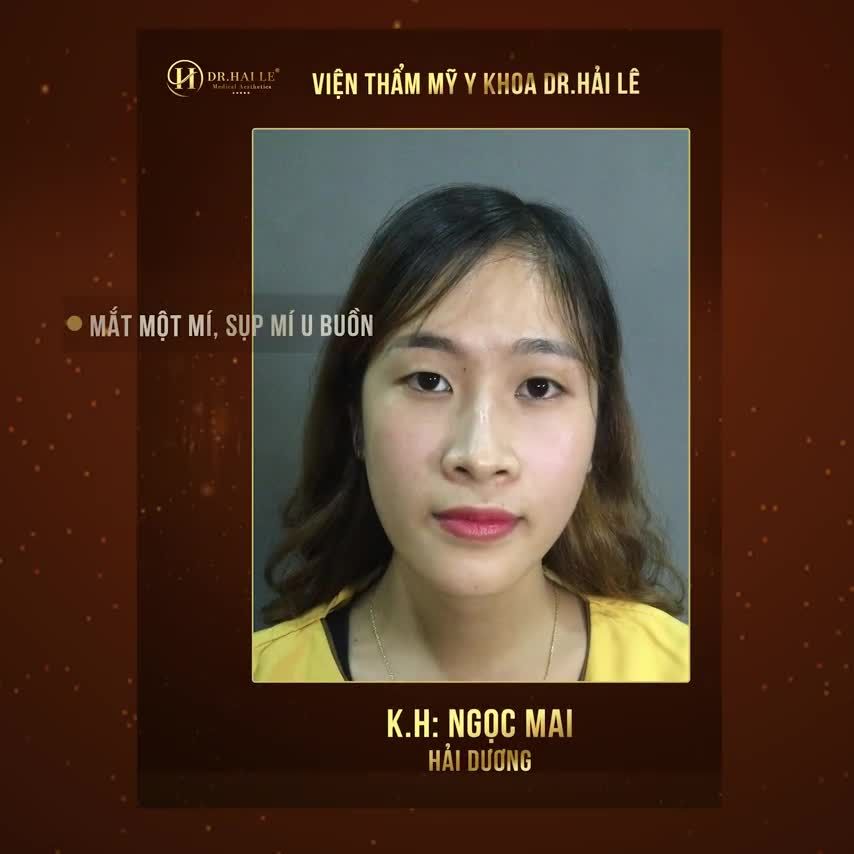 Em biết tới Dr.Hải Lê qua một chị giới thiệu Với cả nhiều người cắt mí ở đây xong đều khen đẹp, tự nhiên