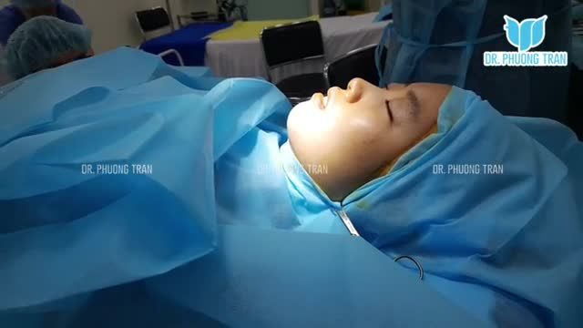 BÁC SĨ PHÂN TÍCH TRƯỚC NÂNG MŨI CẤU TRÚC SURGIFORM