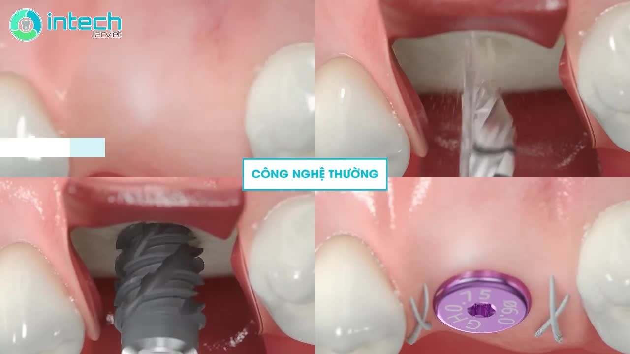 CÔNG NGHỆ CẤY GHÉP IMPLANT USI ĐỘC QUYỀN CÓ KHÁC GÌ VỚI CÔNG NGHỆ THƯỜNG?