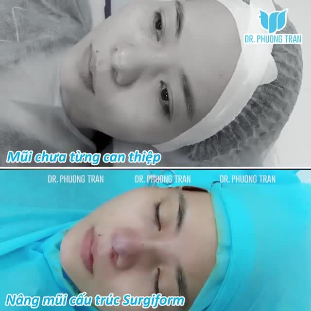 1 chiếc mũi 2 số phận