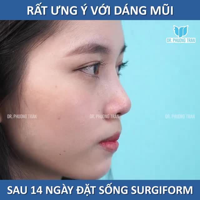 NÂNG MŨI TƯỞNG ĐAU LẮM... THỰC TẾ KHÔNG HỀ ĐAU MIẾNG NÀO. BẠN CÓ CÙNG CẢM NHẬN GIỐNG BẠN ẤY KHÔNG?
