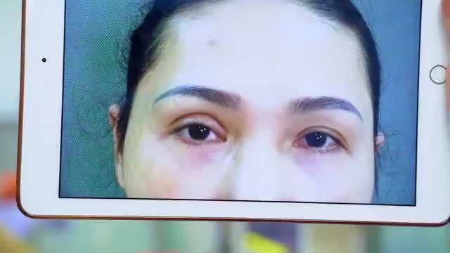 giải cứu thành công ca mí lỗi hỏng cho vị khách hàng có lại đôi mắt đẹp để tự tin đón Tết