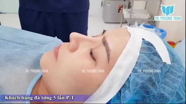 5 Phút để bạn tận tường toàn bộ một ca P.T nâng mũi