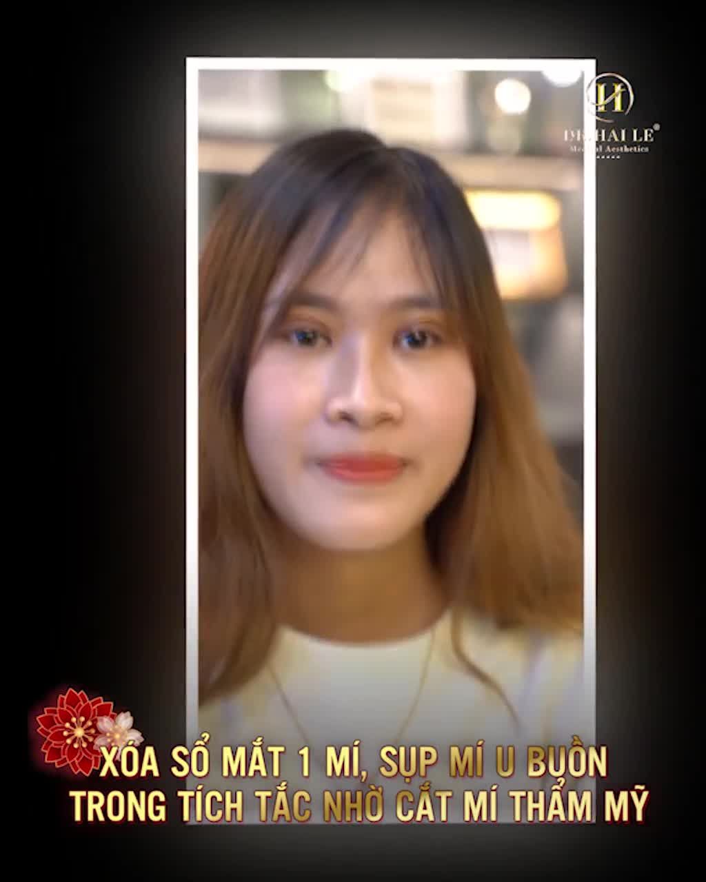 Tết đến rồi Cắt mí thôi chị em ơi