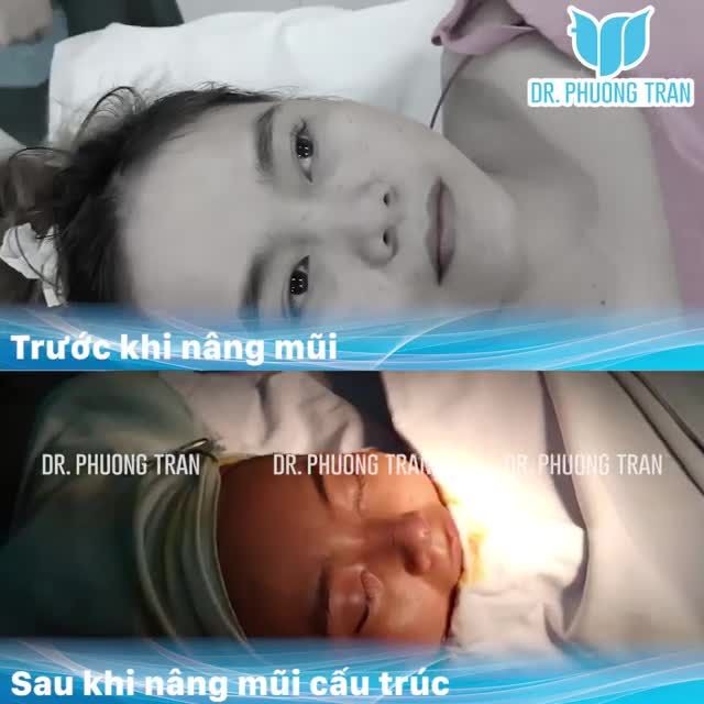 THAY ĐỔI RÕ RỆT NGAY SAU NÂNG MŨI SỤN SƯỜN