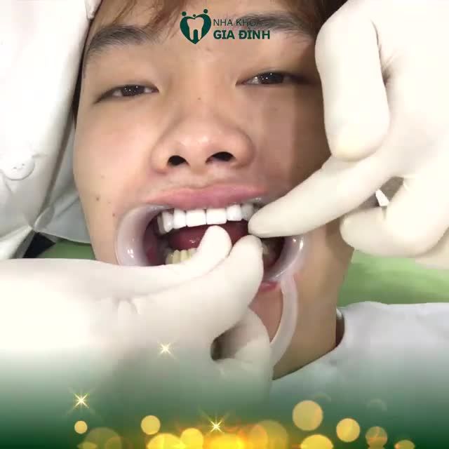 DÁN SỨ VENEER SIÊU PHẨM KIẾN TẠO NỤ CƯỜI HOÀN MỸ