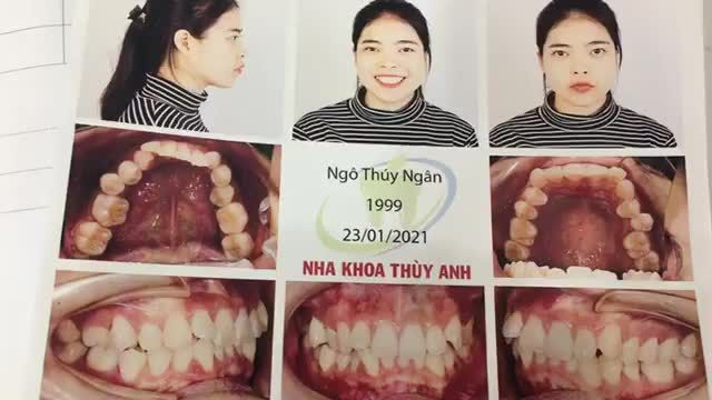 Gắn mắc cài điều trị răng hô và lệch lạc cho bạn Ngân tại nha khoa Thùy Anh. Mời quý vị và các bạn cùng theo dõi.