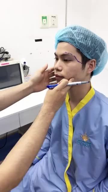 Quá trình đo vẽ cấy mỡ mặt