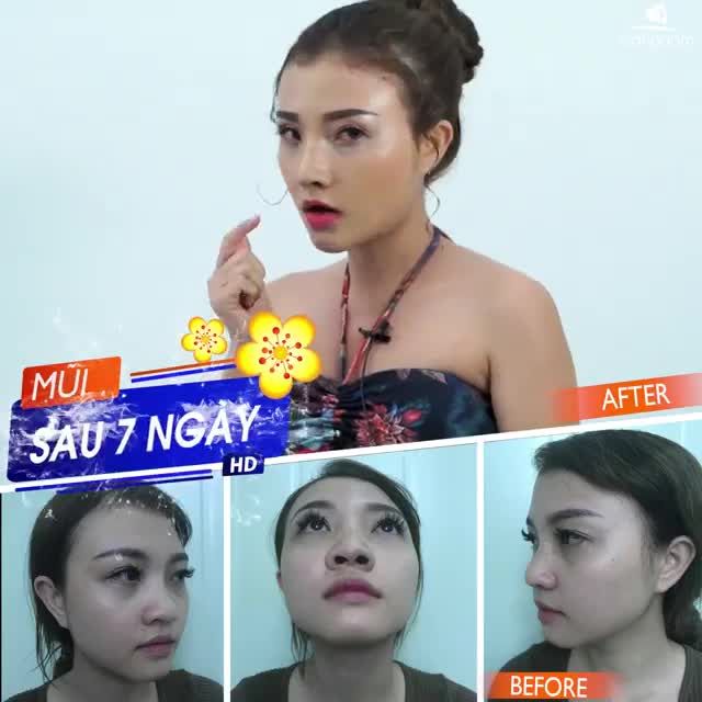 CÓ NÊN NÂNG MŨI SIÊU CAO (QUÁ CAO)?