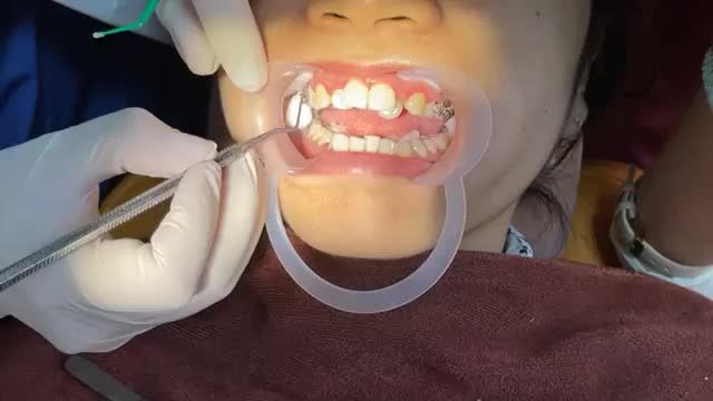 Gắn mắc cài cho bệnh nhân răng KHẤP KHỂNH HÔ
