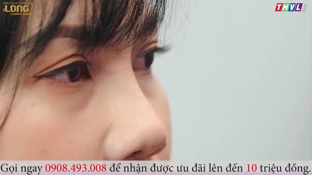 Huyền Trang sau 25 ngày phẫu thuật nâng mũi