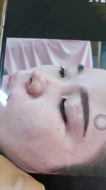 Nâng mũi Bán cấu trúc sụn tai 2 lớp Khách hàng tái khám sau 10 ngày phẫu thuật.