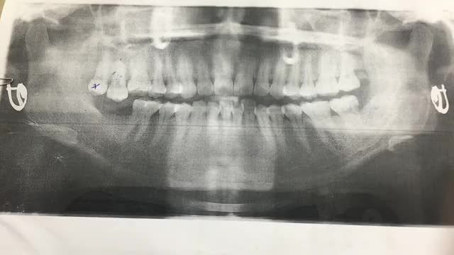 cấy ghép chân tăng nhân tạo implant 47.