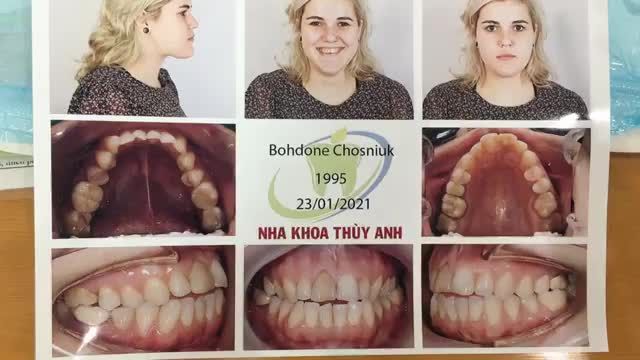 gắn mắc cài điều trị tình trạng răng cắn hở, lệch lạc cho bạn khách hàng nước ngoài tại Nha Khoa Thuỳ Anh.