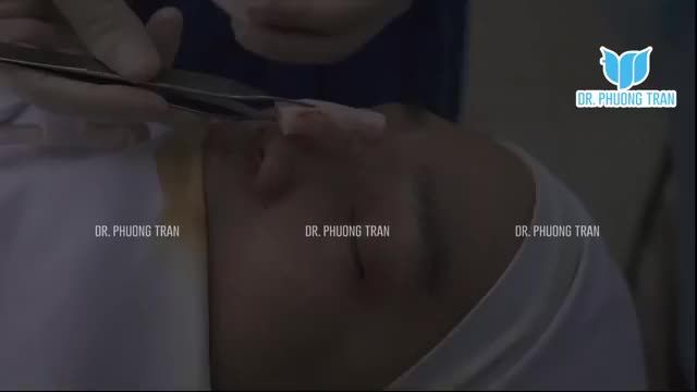 NÂNG MŨI SỤN SƯỜN TOÀN PHẦN CHO KHÁCH HÀNG ĐÃ TỪNG NÂNG MŨI CHỈ