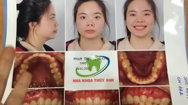 Ca gắn mắc cài điều trị khớp cắn sâu tại Nha Khoa Thùy Anh.