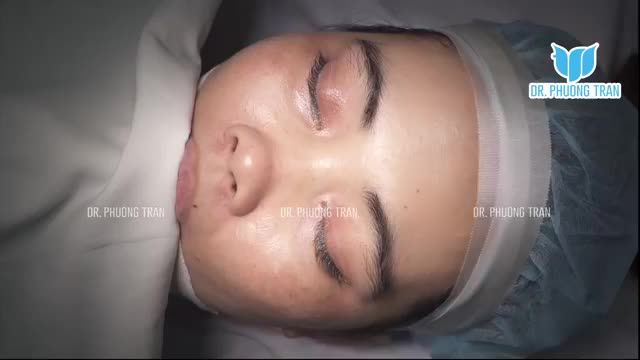 MŨI NGẮN, GẦN NHƯ KHÔNG CÓ SỐNG MŨI, DA MŨI MỎNG THÌ NÂNG MŨI THẾ NÀO CHO AN TOÀN?
