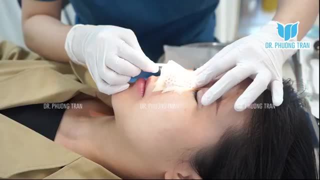 CẬN CẢNH MŨI, MÍ SAU 7 NGÀY PHẪU THUẬT