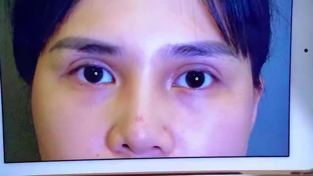 Ca giải cứu mí hỏng thứ N và vẫn chưa dừng lại  Lời cảnh tỉnh cho khách hàng không nên nhẹ dạ cả tin gửi gắm nhan sắc của mình những cơ sở không uy tín