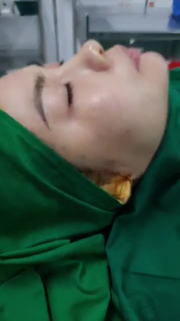 Ghép mỡ mặt baby bằng mỡ tự thân Kết quả sau 45 phút