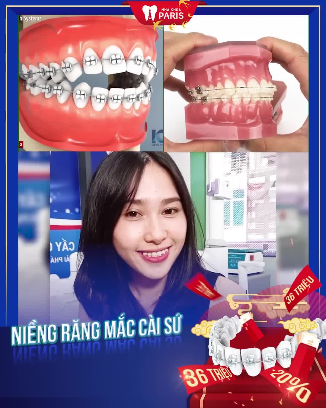 Niềng Răng Giá Tốt Ngại Gì Không Hốt