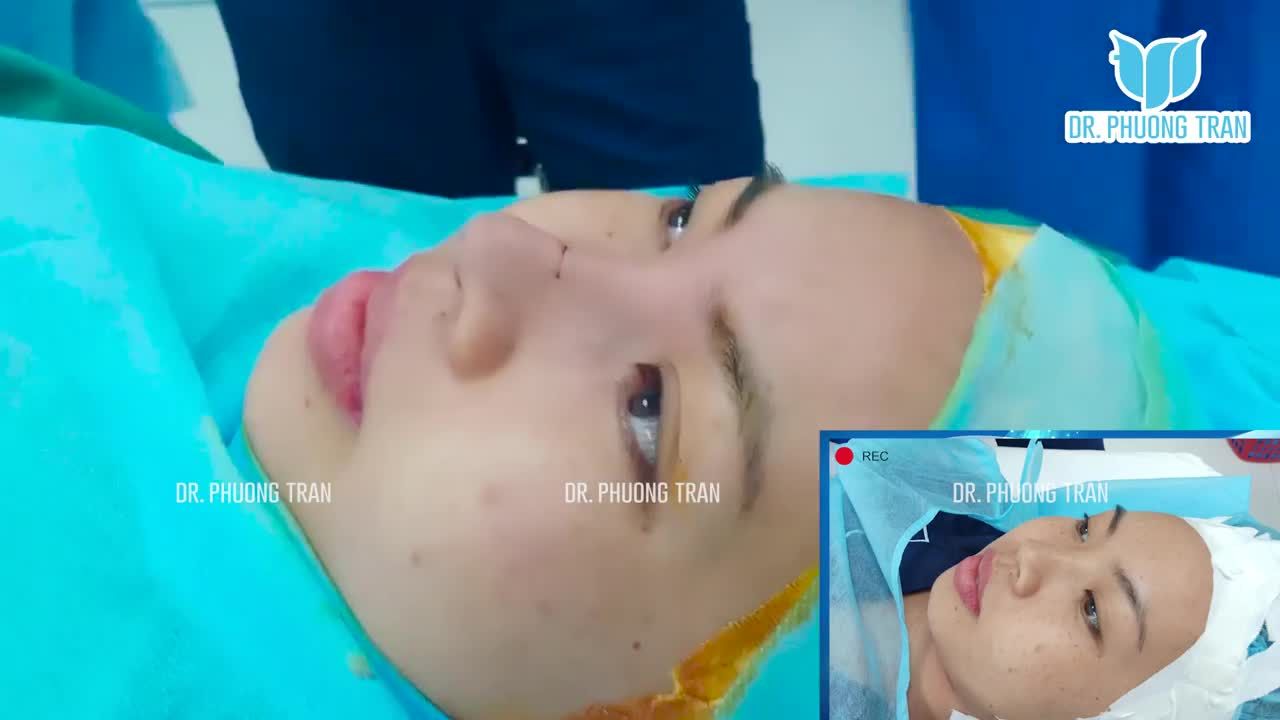 Thích nâng mũi tự nhiên và cái kết