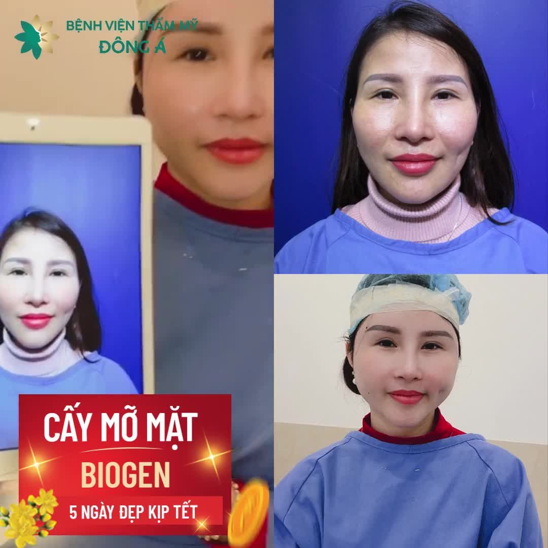 Trầm trồ kết quả CẤY MỠ MẶT Biogen sau 45 phút tại BVTM Đông Á