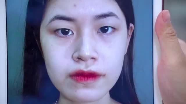 Mắt đẹp xinh chỉ sau 7 ngày thực hiện Cắt mí chỉ có tại Dr.Hải Lê