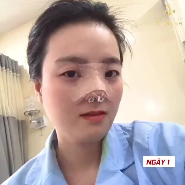 CLIP TÁI HIỆN CHÂN THỰC DÁNG MŨI SAU 12 NGÀY NÂNG CẤU TRÚC TẠI TUẤN LINH