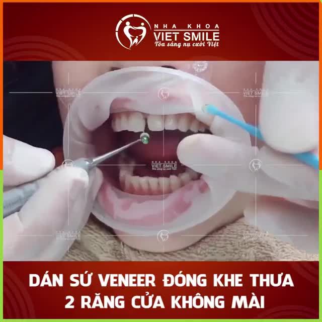 Cùng xem quá trình dán sứ veneer đóng kẽ thưa 2 răng cửa không mài tại Nha khoa Việt Smile