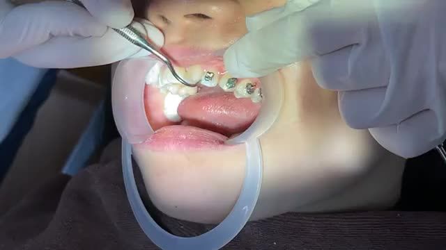 Gắn mắc cài cho bệnh nhân răng CẮN ĐỐI ĐỈNH
