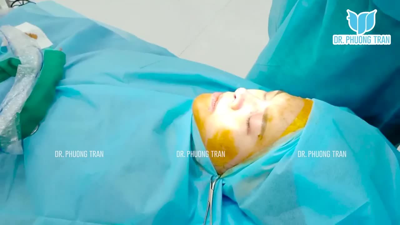 Mũi cải thiện rõ ràng nhưng vẫn rất tự nhiên