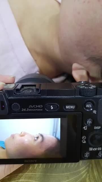 Nâng mũi Bán cấu trúc sụn tai đa lớp Khách hàng tái khám sau 5 ngày phẫu thuật.