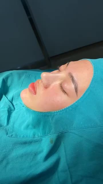 NÂNG MŨI CAO SANG THĂNG HẠNG NHAN SẮC
