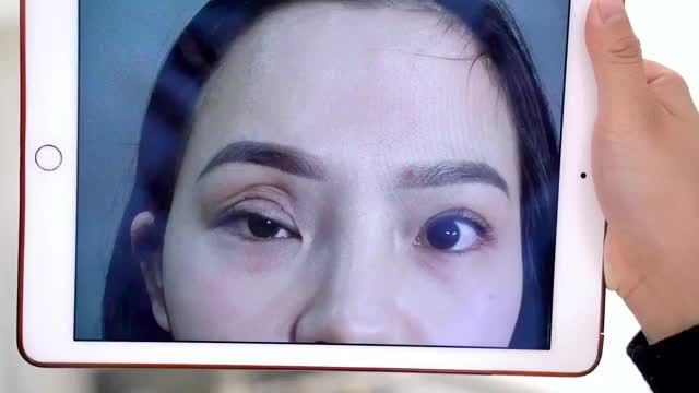 Bs Hải Lê cấp cứu GIẢI CỨU thành công ca mí lỗi hỏng nặng mới 10 ngày làm mí tại cơ sở ko uy tín dẫn đến thủng kết mạc Đứt cơ nâng mi gây liệt cơ mắt Co dính trần mí mắt.