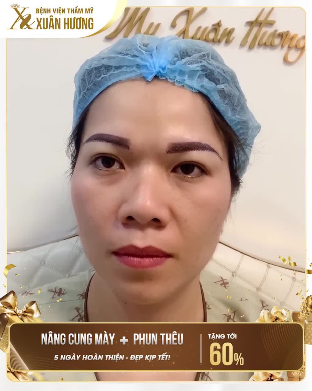 NÂNG CUNG MÀY KẾT HỢP PHUN THÊU ĐẸP TỰ NHIÊN TẠI BVTM XUÂN HƯƠNG